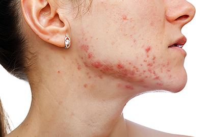 acne